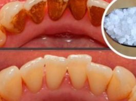 Внимание! Как избавиться от зубного камня без помощи стоматолога