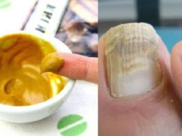 Как избавиться от грибка ногтей быстро и навсегда